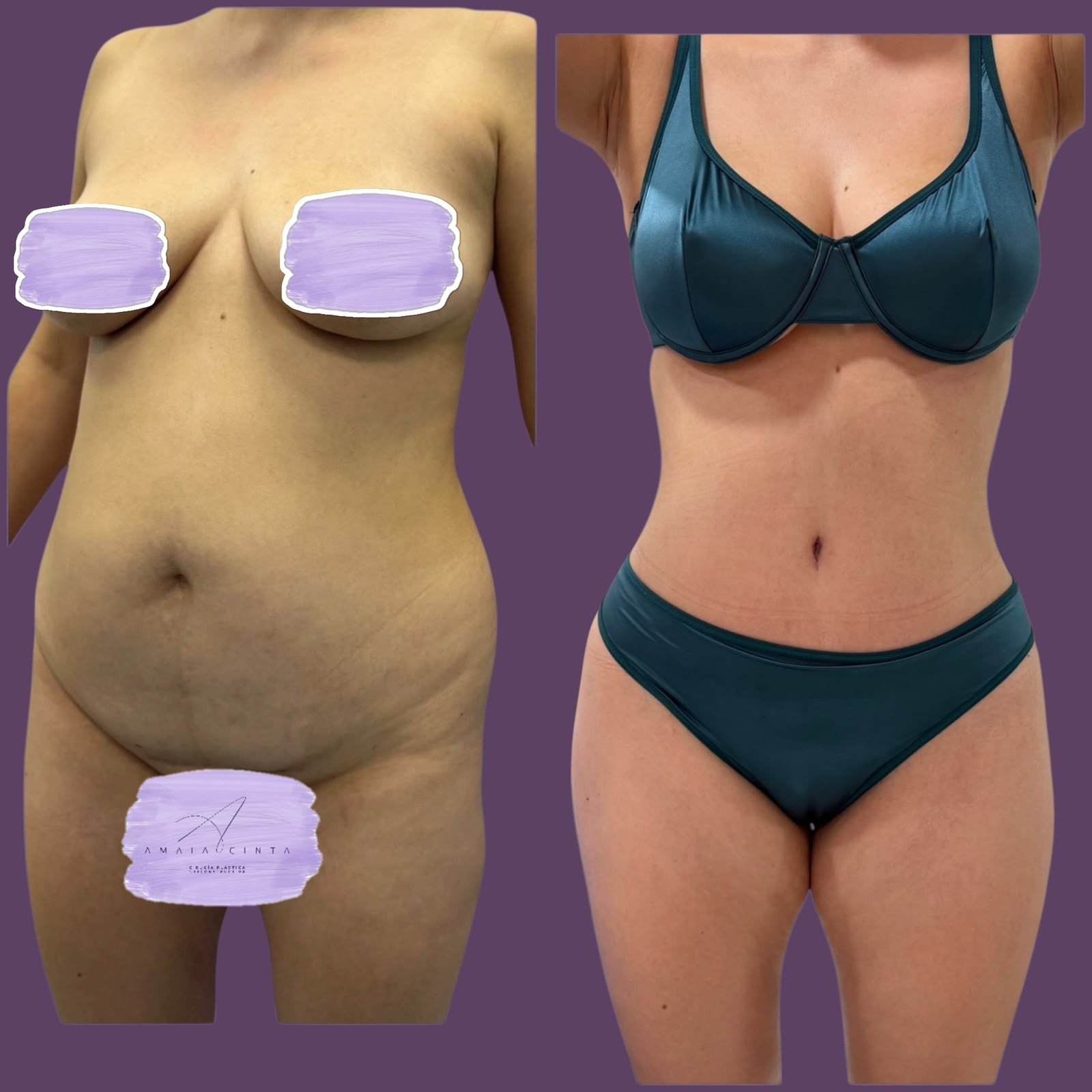 Antes y después de abdominoplastia y lipoescultura, caso 1