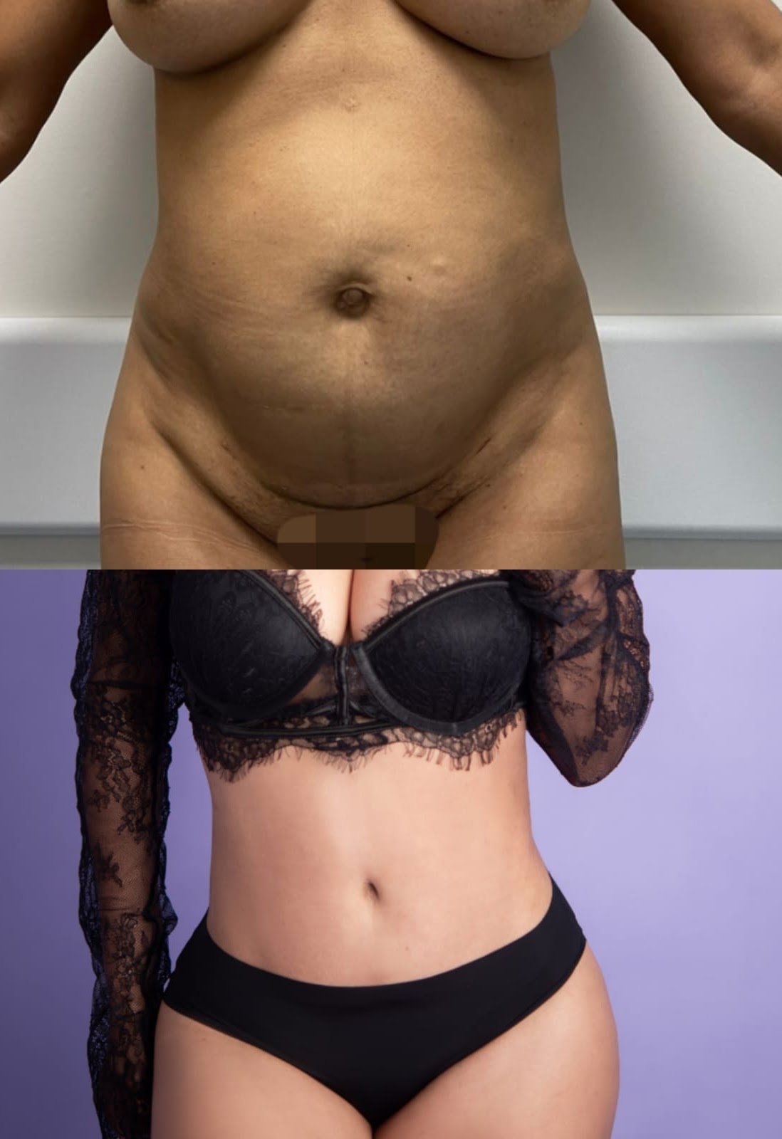 Antes y después de abdominoplastia y lipoescultura, caso 2