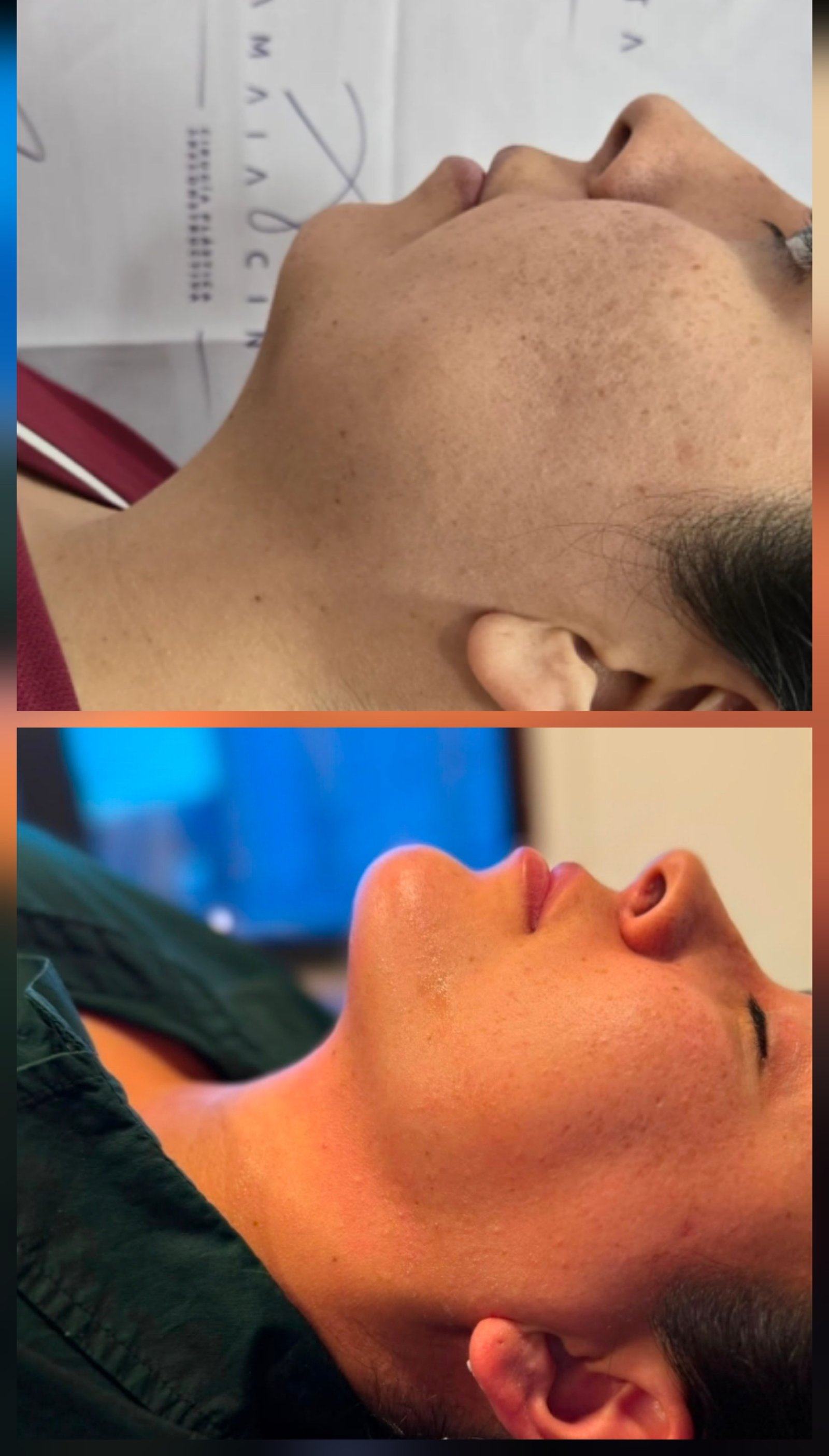Antes y después de lipoescultura de cuello y mentoplastia