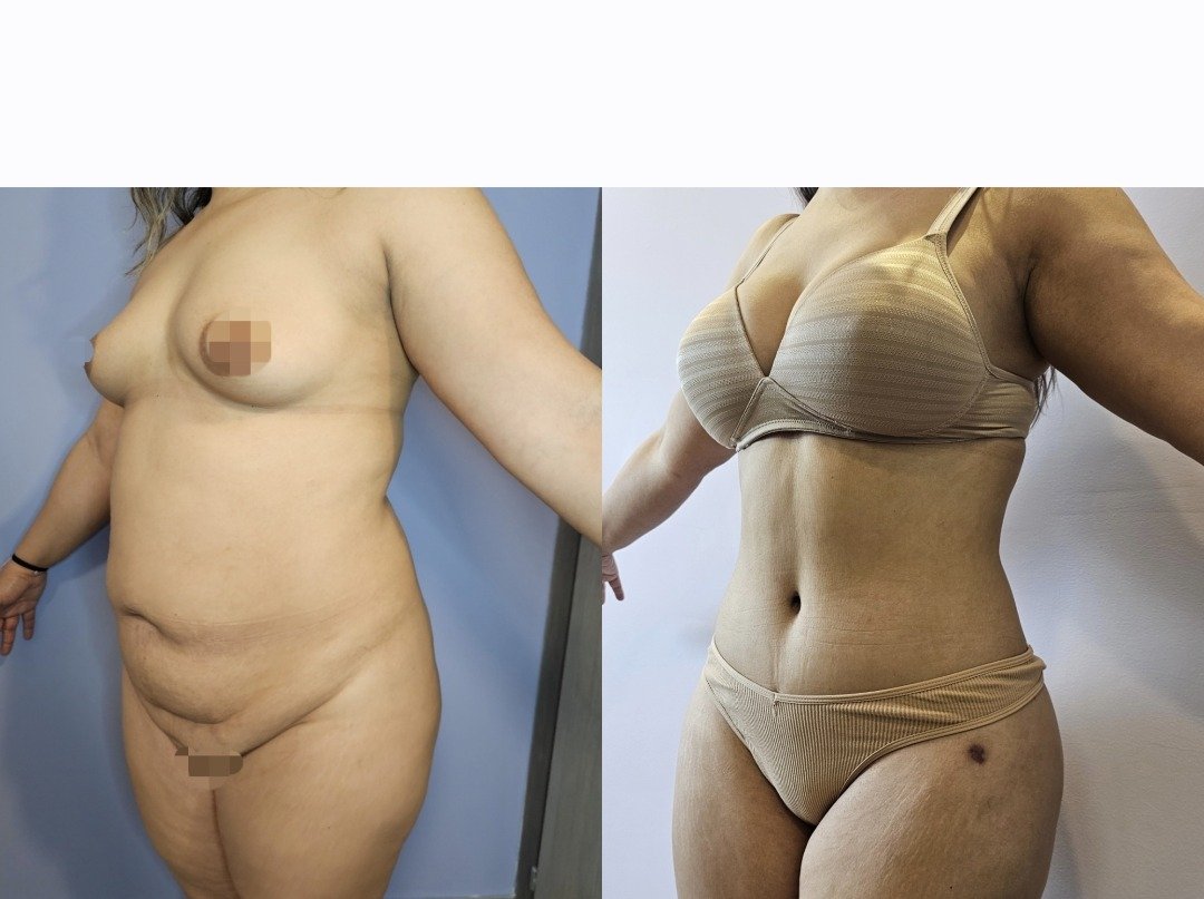 Antes y después de mommy makeover, caso 2