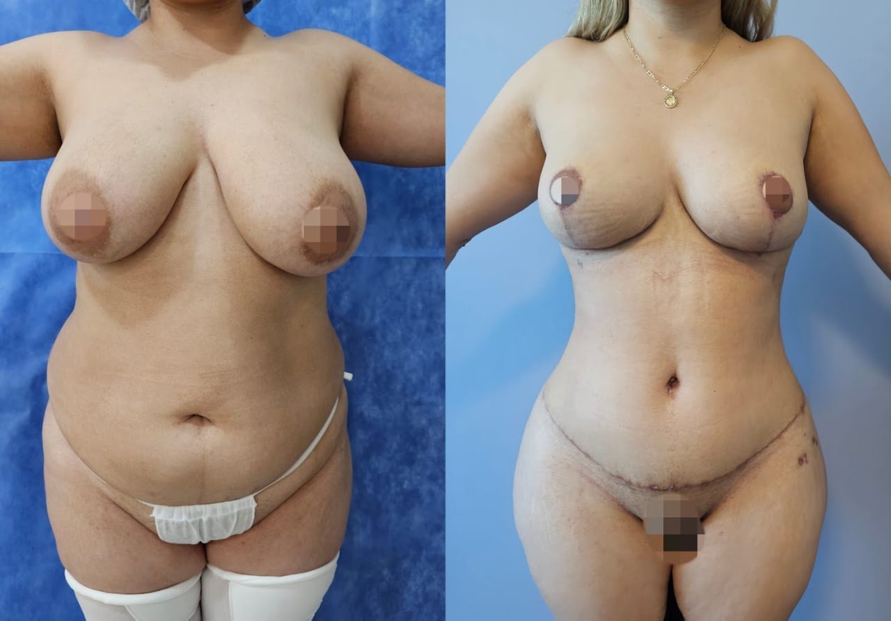 Antes y después de mommy makeover, caso 3