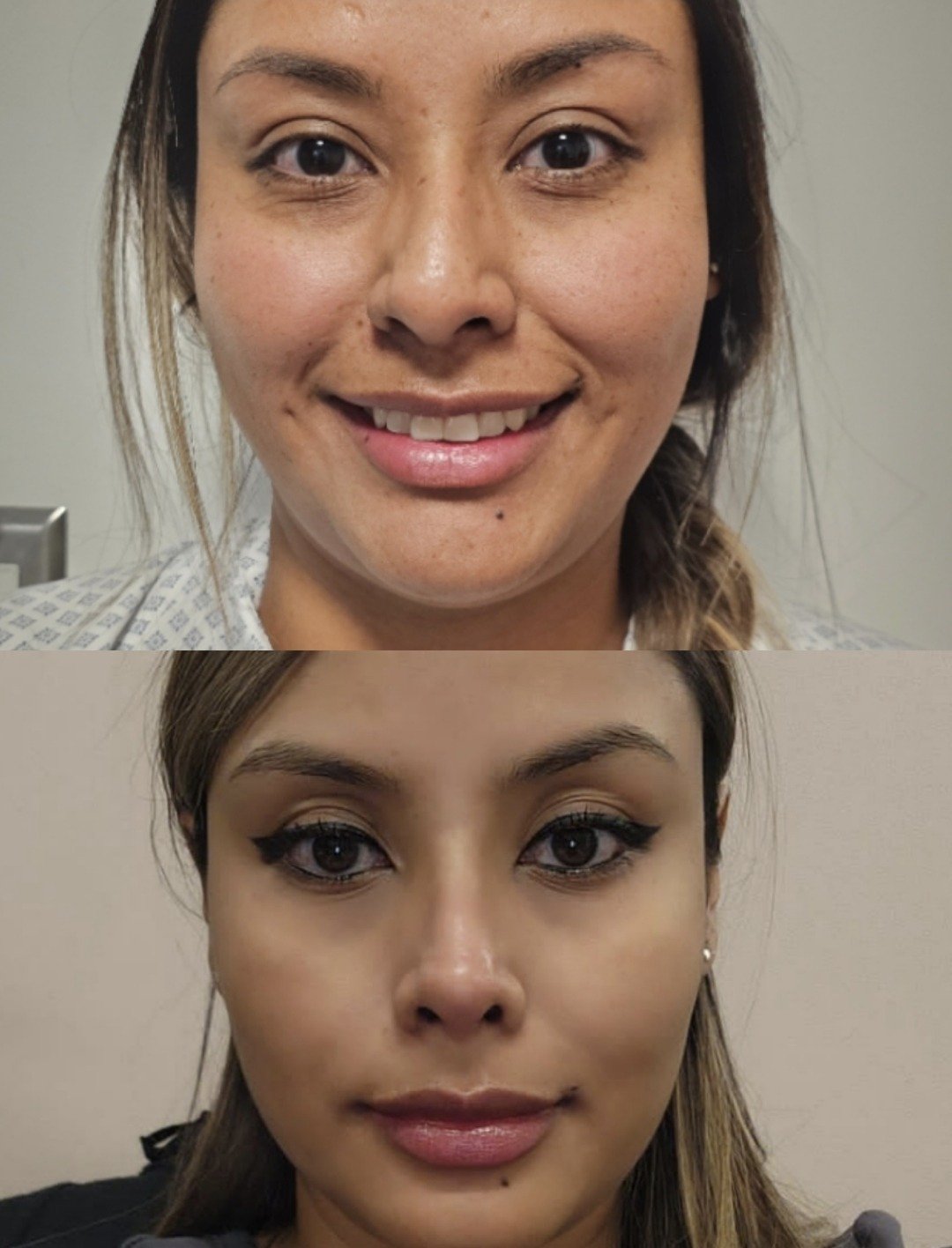 Antes y después de rinoplastia, caso 1, frente