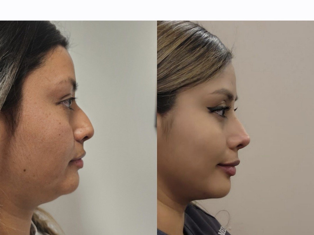Antes y después de rinoplastia, caso 1, perfil