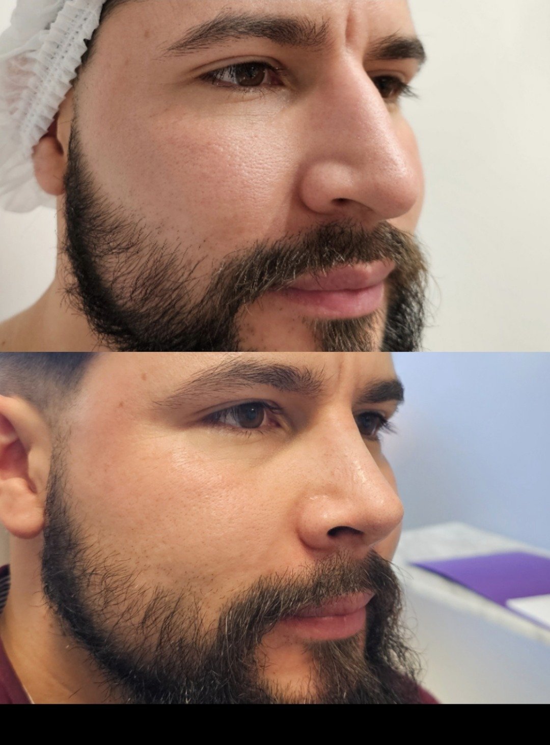 Antes y después de rinoplastia, caso 2